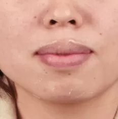 治療前の顔の写真